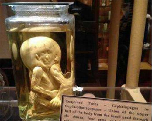 世界上最恐怖的博物館：雙頭尸體，愛(ài)因斯坦大腦切片都在這